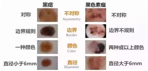 長痣的位置|“ABCDE法”——自我识别痣的良性与恶性